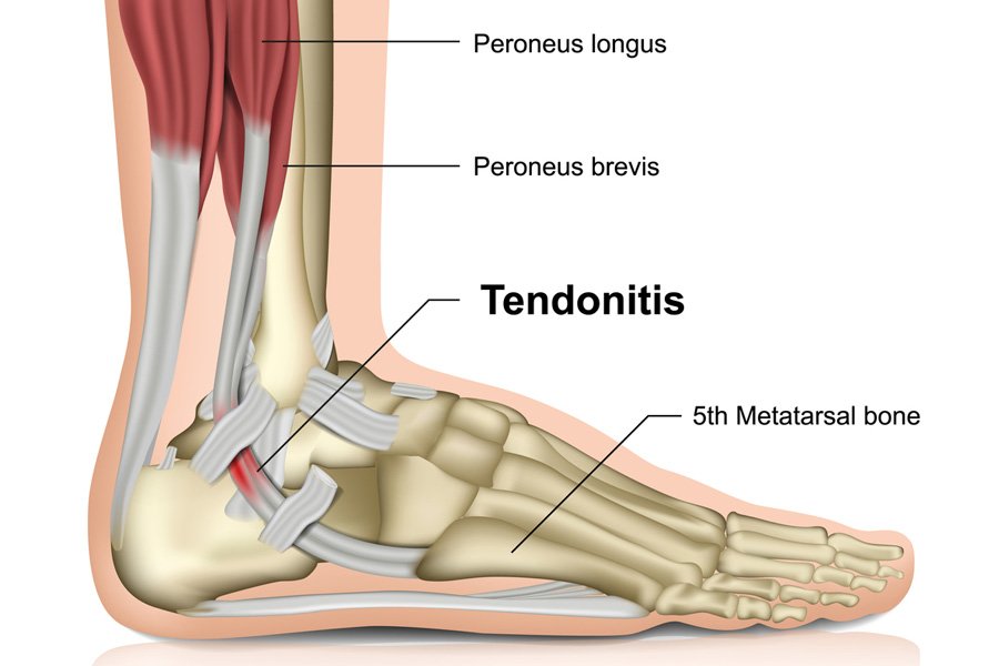 Peroneal tendinitis